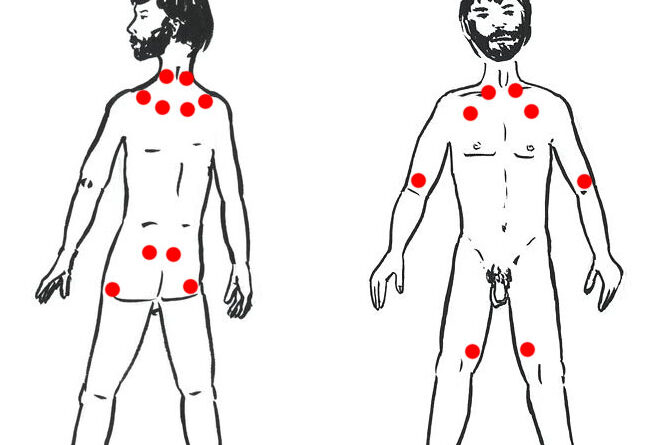 Quem tem fibromialgia pode fazer liberação miofascial?