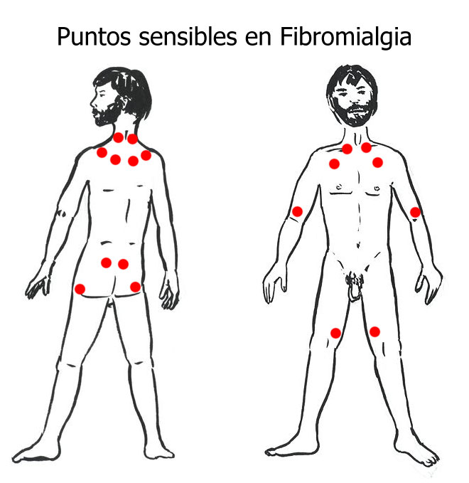 Quem tem fibromialgia pode fazer liberação miofascial?