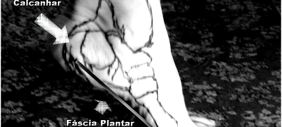 Qual a causa emocional da fascite plantar?