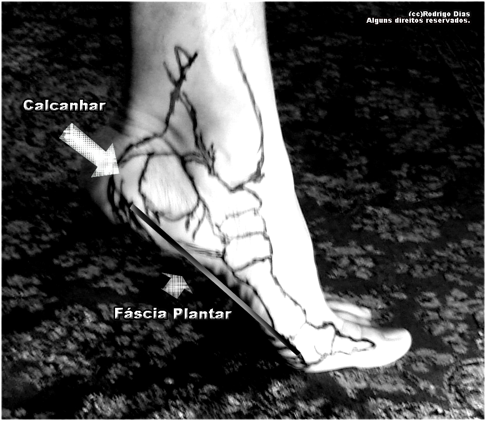 Qual a causa emocional da fascite plantar?